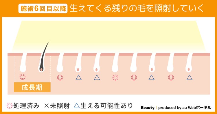 施術6回目以降 生えてくる残りの毛を照射していく