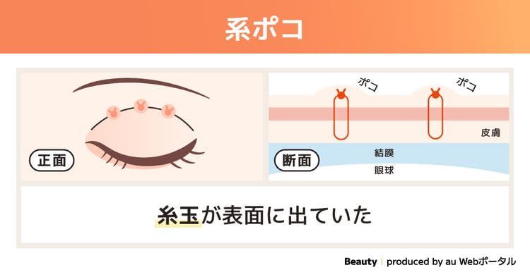 糸ポコを説明する画像