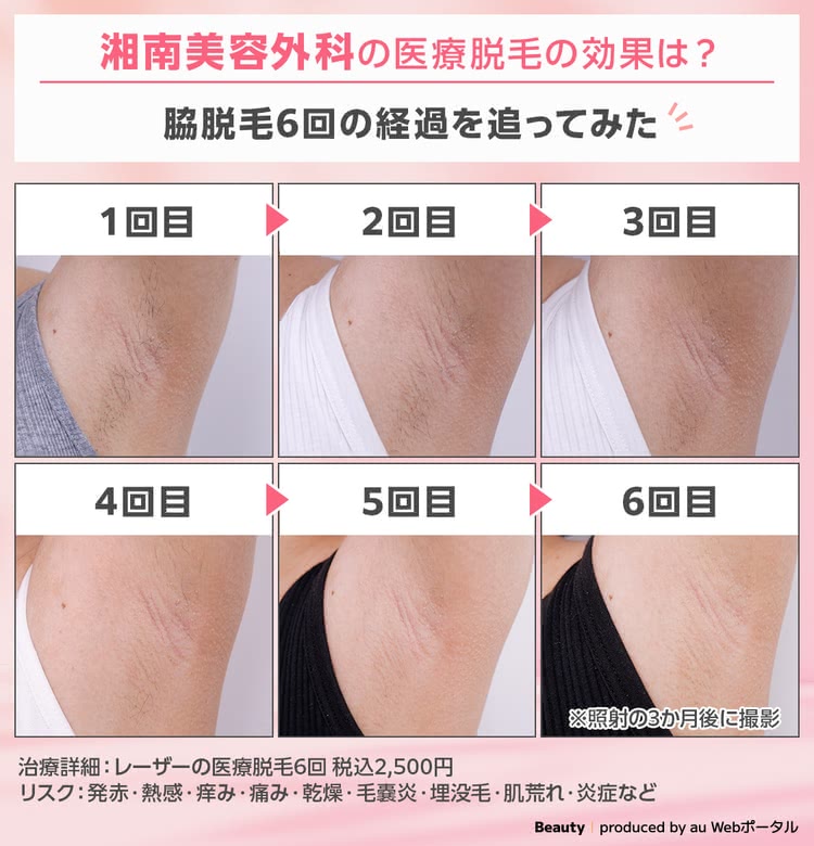 脇の医療脱毛を5回受けたBEAUTY編集部員