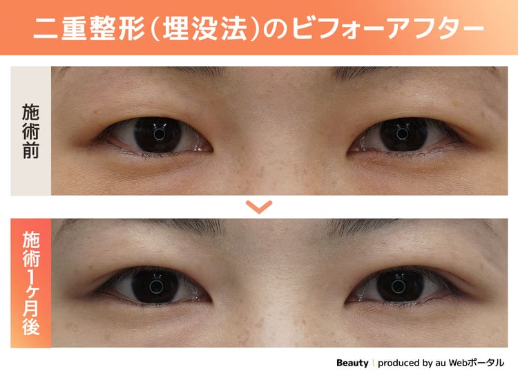 Beauty編集部が埋没法をしたビフォーアフター