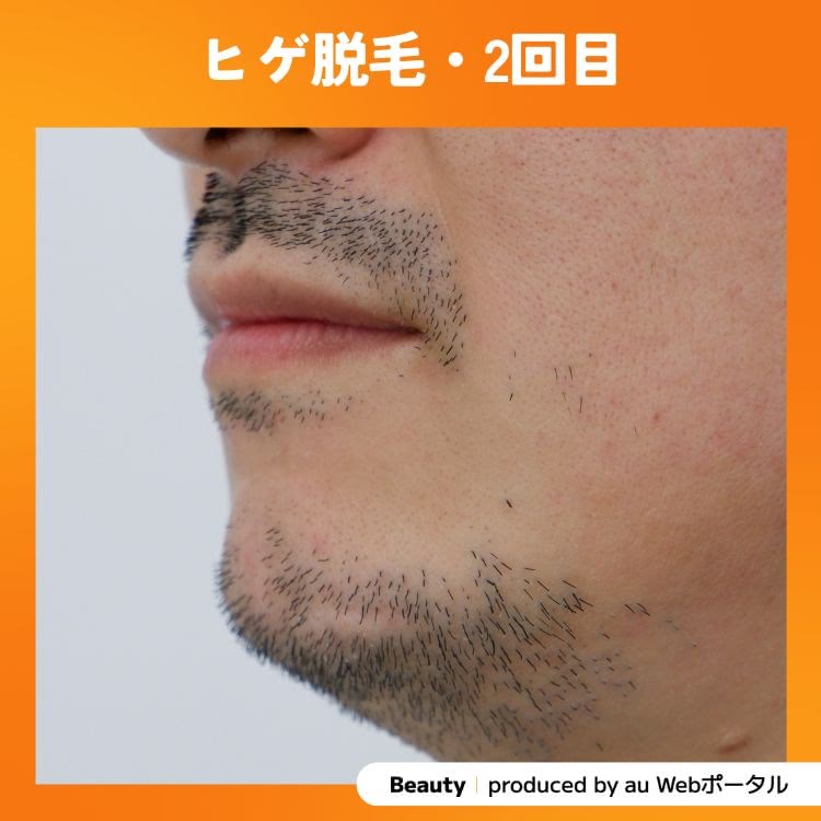 Beauty編集部員のヒゲ脱毛2回目の症例