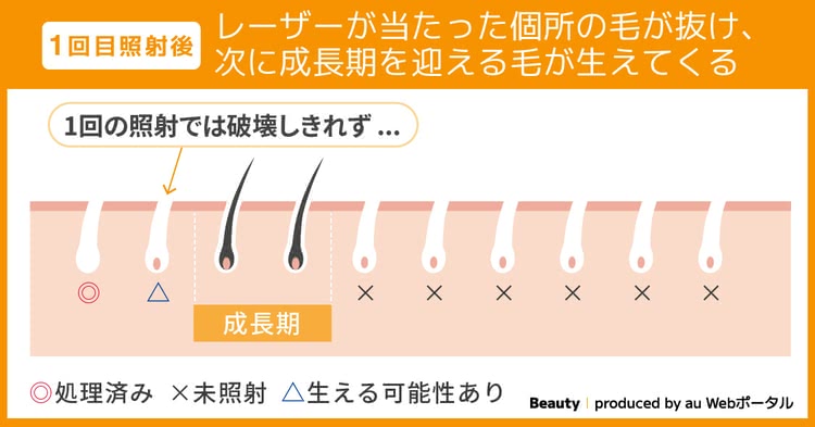 1回目照射後 レーザーが当たった個所の毛が抜け、次に成長期を迎える毛が生えてくる