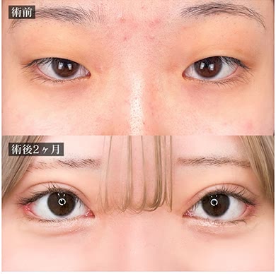 TCB東京中央美容外科の二重整形の症例写真