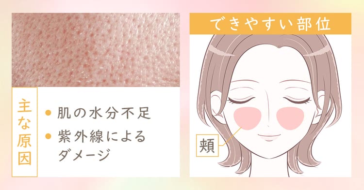 「乾燥開き毛穴」主な原因：肌の水分不足／紫外線によるダメージ　できやすい部位：頬