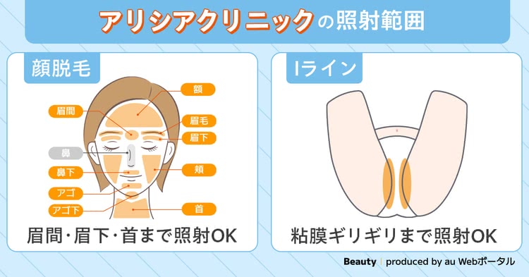 アリシアクリニックの照射範囲について解説するイラスト