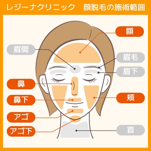 レジ―ナクリニックの顔脱毛の施術範囲