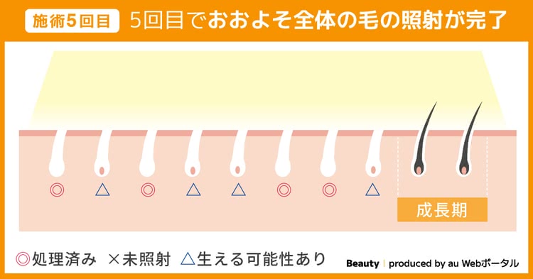 施術5回目 5回目でおおよそ全体の毛の照射が完了