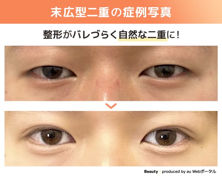 自然な末広型二重の症例写真
