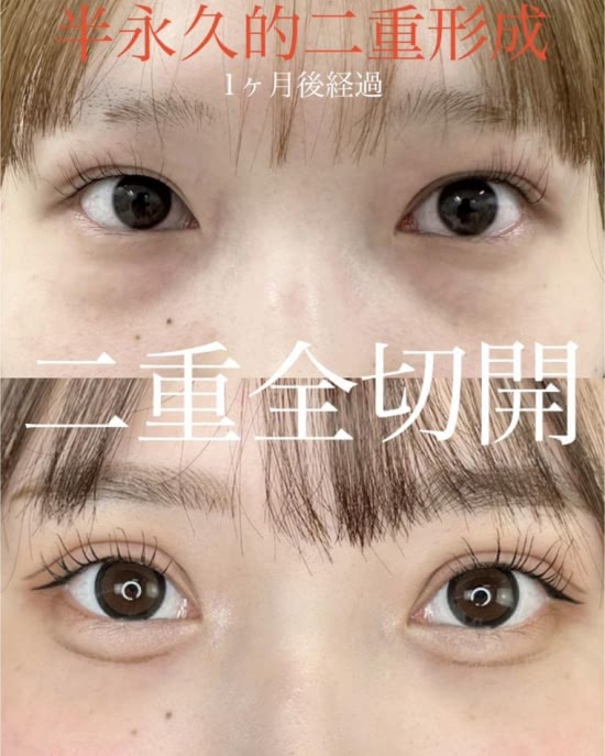 ルラ美容クリニックの二重整形の症例写真