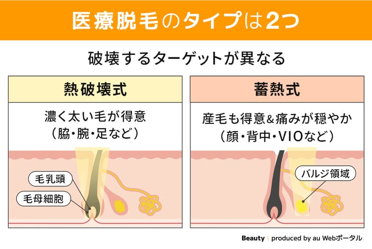 熱破壊式と蓄熱式脱毛機の違い