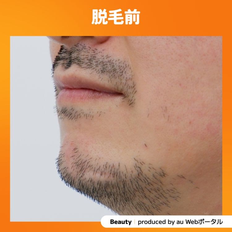 Beauty編集部員のヒゲ脱毛の照射前