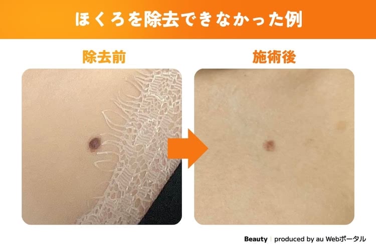 ほくろ除去できなかった症例写真