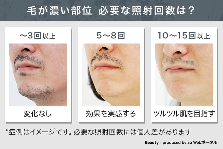 ヒゲ脱毛で必要な照射回数のイメージ画像