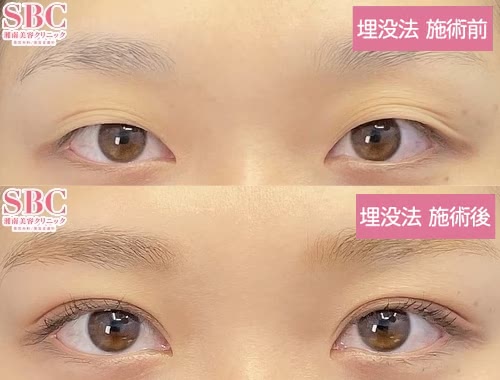 SBC湘南美容クリニックの二重整形の症例写真