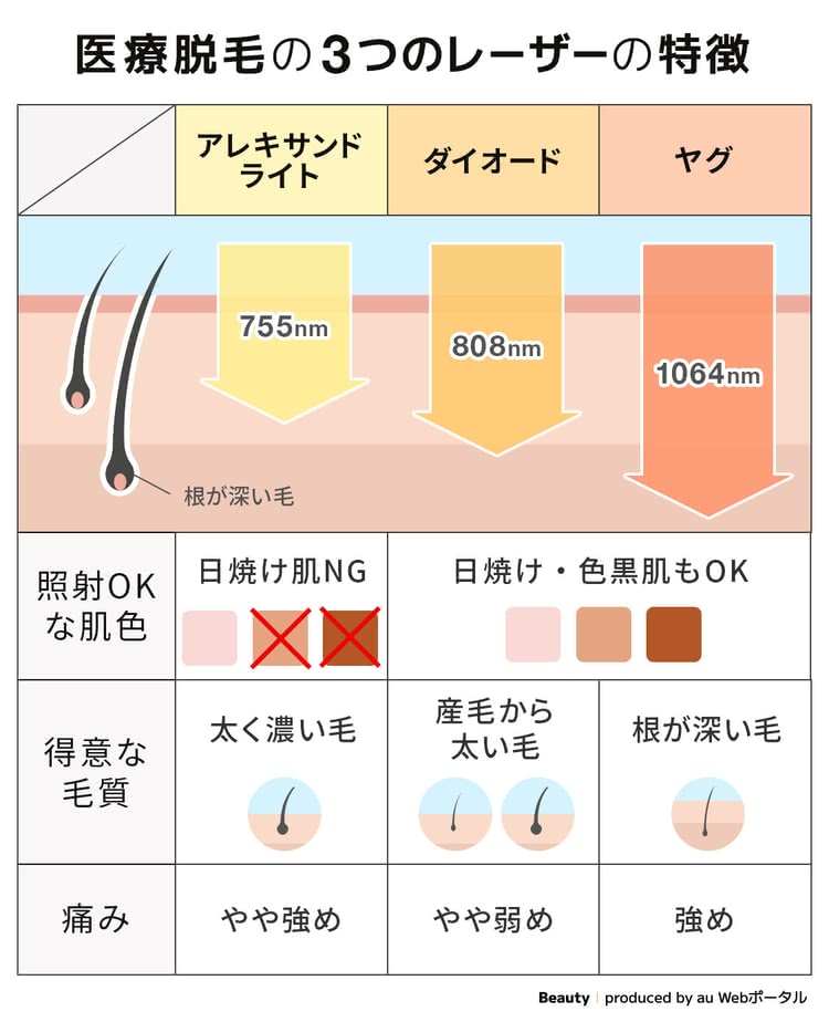 脱毛機のレーザー3種類の特徴を解説した画像