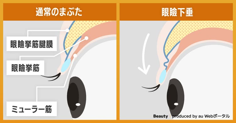 まぶたのたるみに見える眼瞼下垂のメカニズムを解説した画像