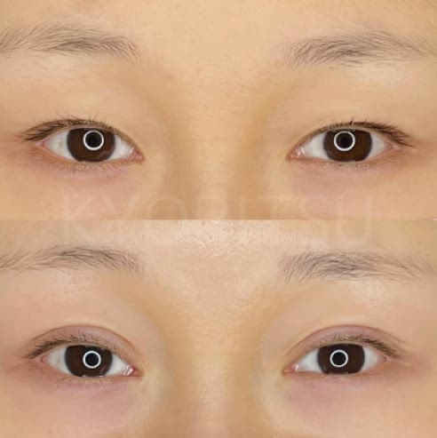 共立美容外科の二重整形の症例写真