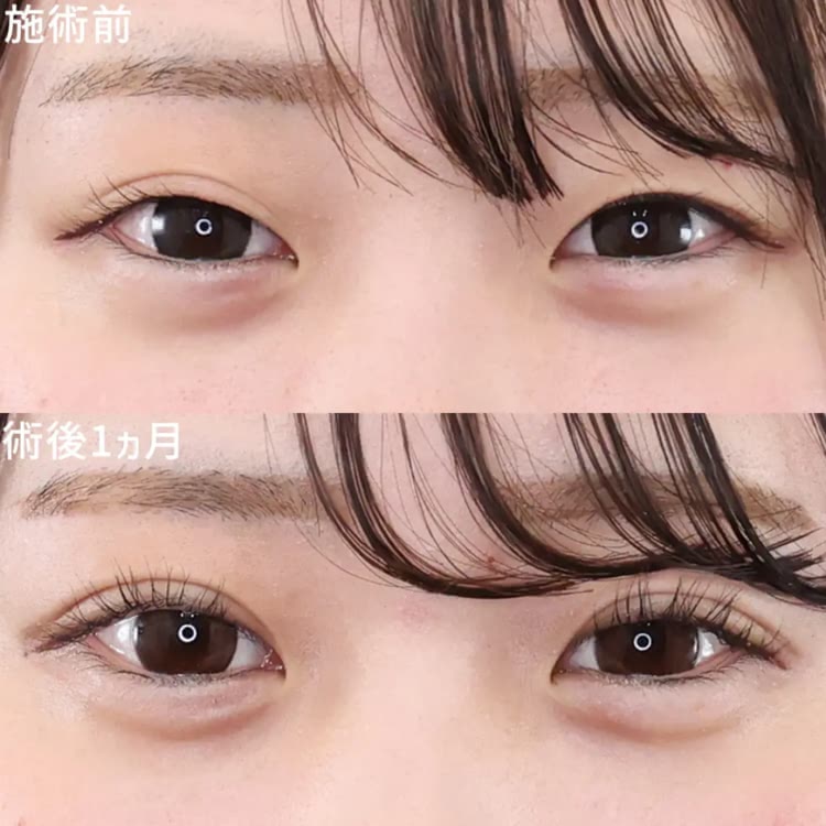 TAクリニックの二重整形の症例写真
