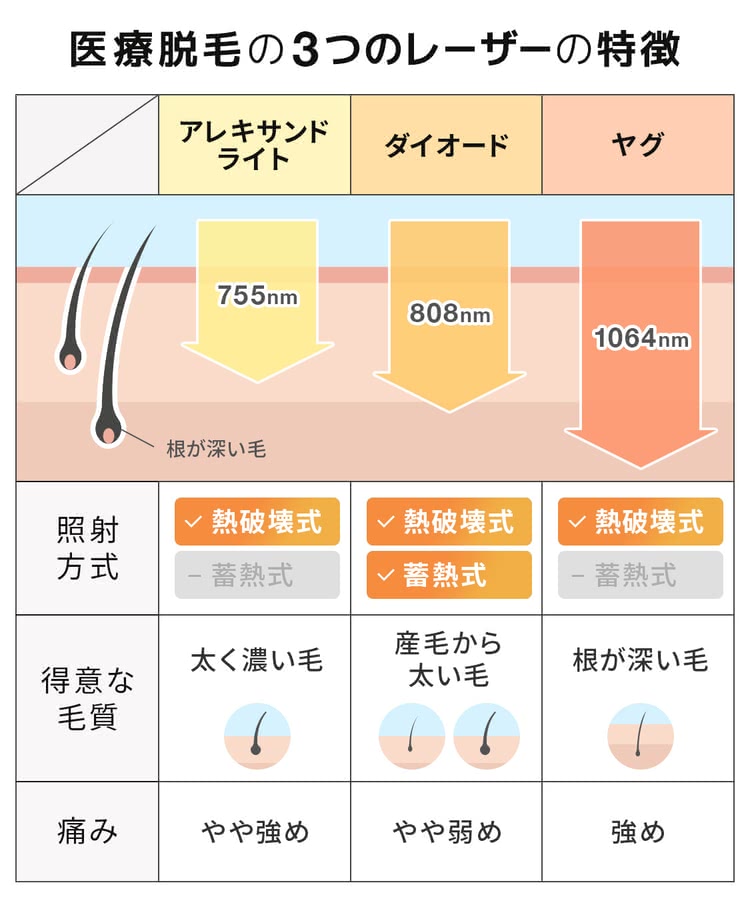 医療脱毛で使用する3種類のレーザーを解説するイラスト