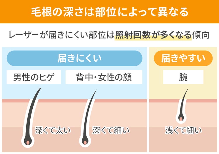 毛根の深さによってレーザーが当たりづらいことを解説するイラスト