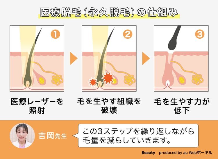 医療脱毛（永久脱毛）の仕組み