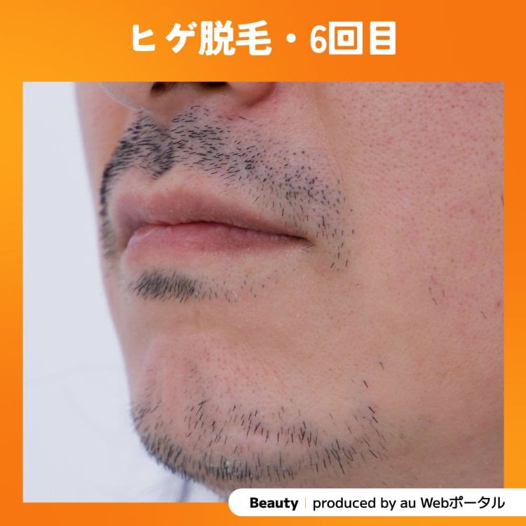 Beauty編集部員のヒゲ脱毛6回目の症例