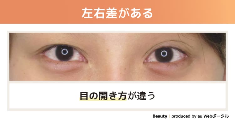 左右差がある二重