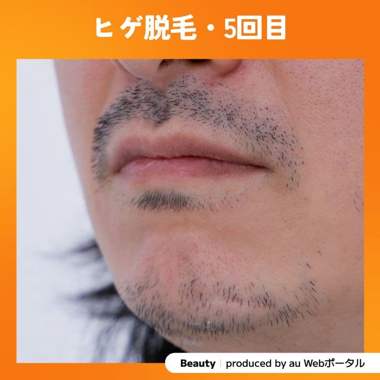 Beauty編集部員のヒゲ脱毛5回目の症例