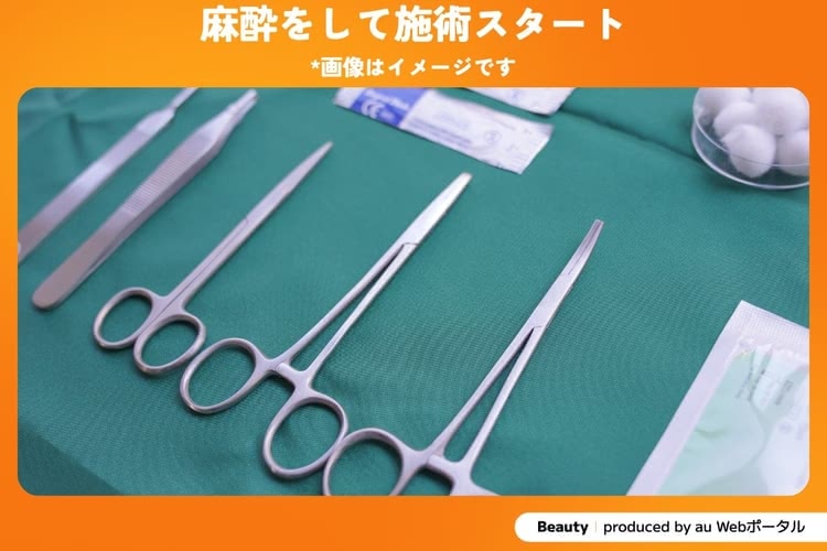 二重整形のイメージ画像