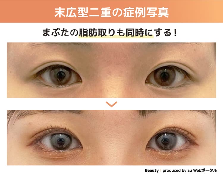 まぶたの脂肪取りも同時にする症例写真