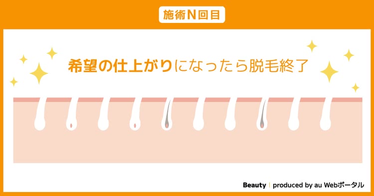 施術n回目 希望の仕上がりになったら脱毛終了