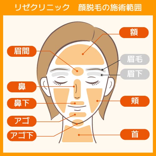 リゼクリニックの顔脱毛の施術範囲