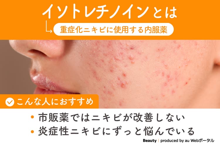 イソトレチノインは重症化ニキビの治療に使用する内服薬