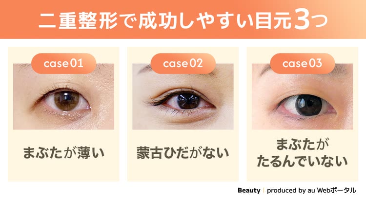 二重整形が成功しやすい目元を解説