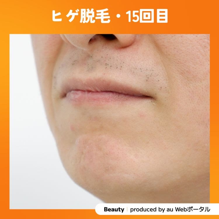 Beauty編集部員のヒゲ脱毛15回目の症例