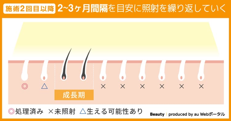 施術2回目以降 2～3ヶ月間隔を目安に照射を繰り返していく