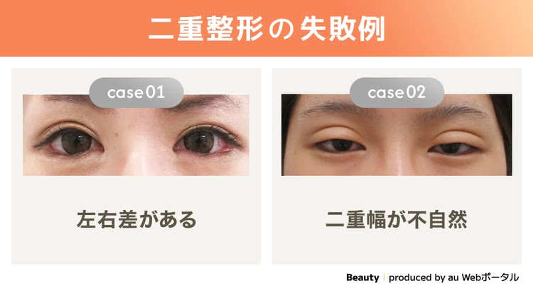 二重整形の失敗例