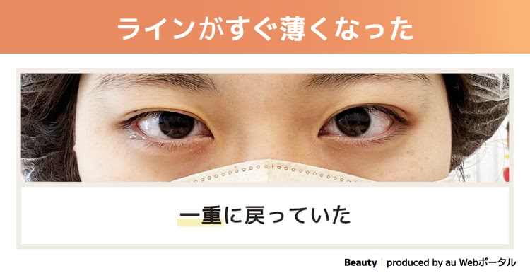 ラインが薄い二重