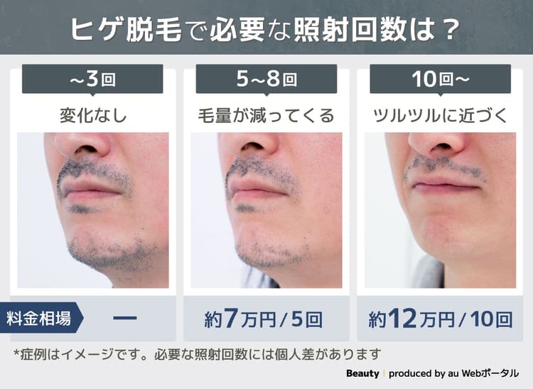 ヒゲ脱毛で必要な照射回数のイメージ画像