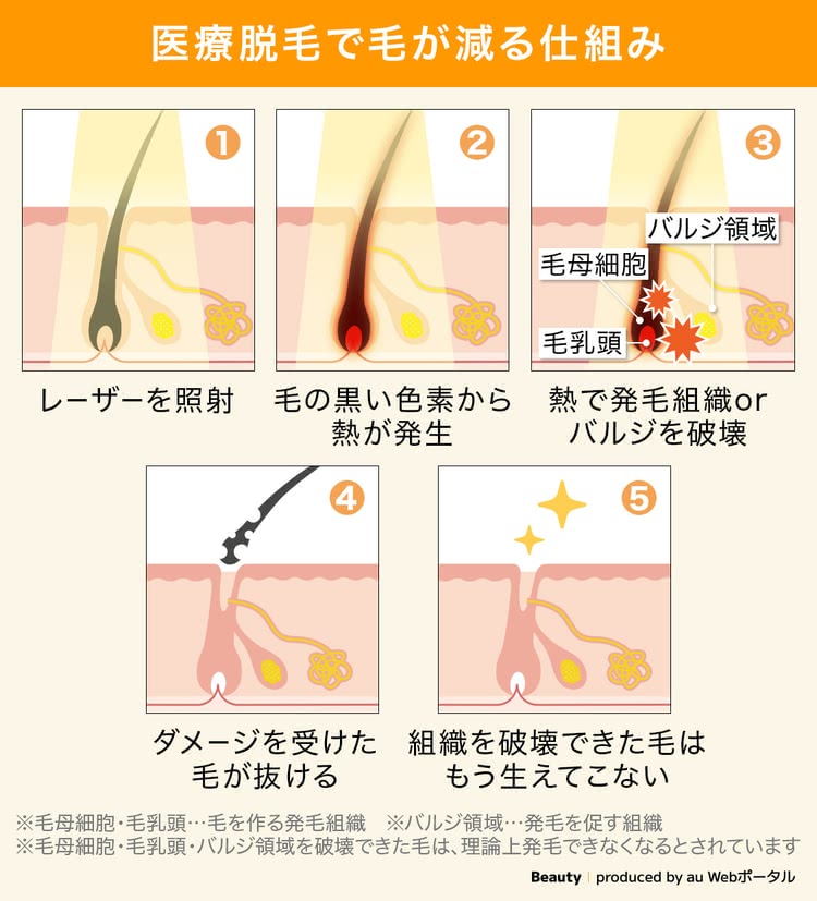 医療脱毛で毛が減る仕組み