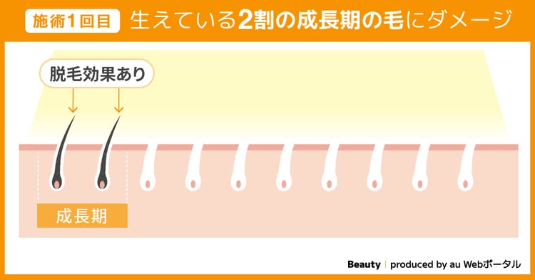 施術1回目 生えている2割の成長期の毛にダメージ