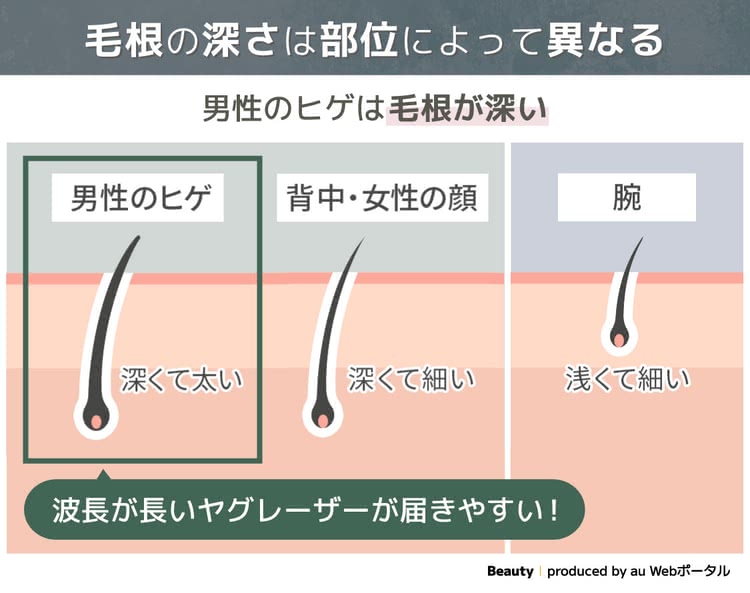 毛根の深さによってレーザーが当たりづらいことを解説するイラスト