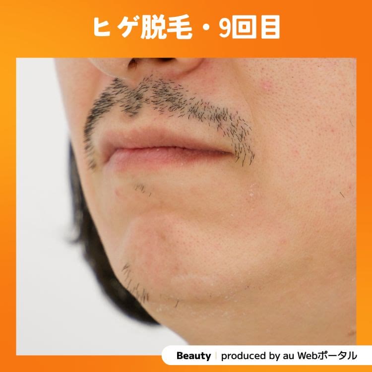 Beauty編集部員のヒゲ脱毛9回目の症例