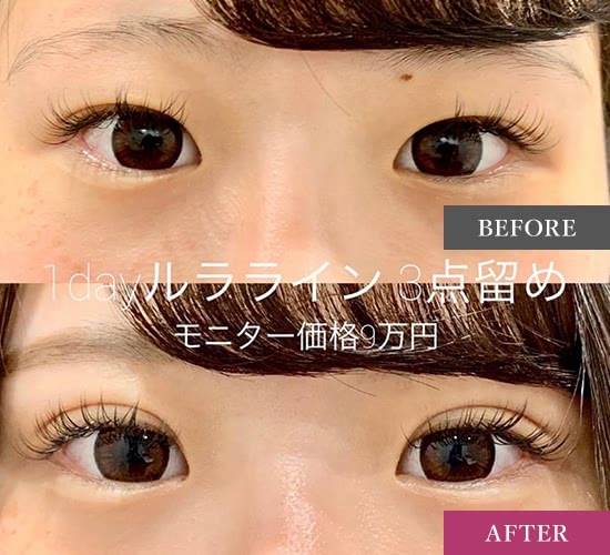 ルラ美容クリニックの二重整形の症例写真