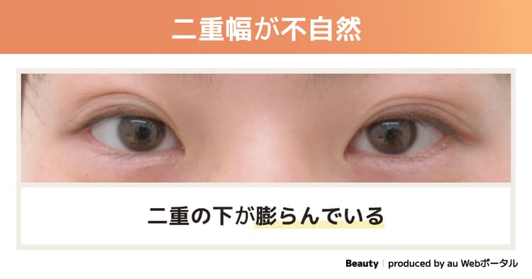 二重幅が不自然な二重