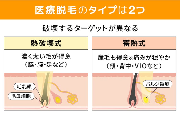 医療脱毛の熱破壊式と蓄熱式の違いについて解説する図