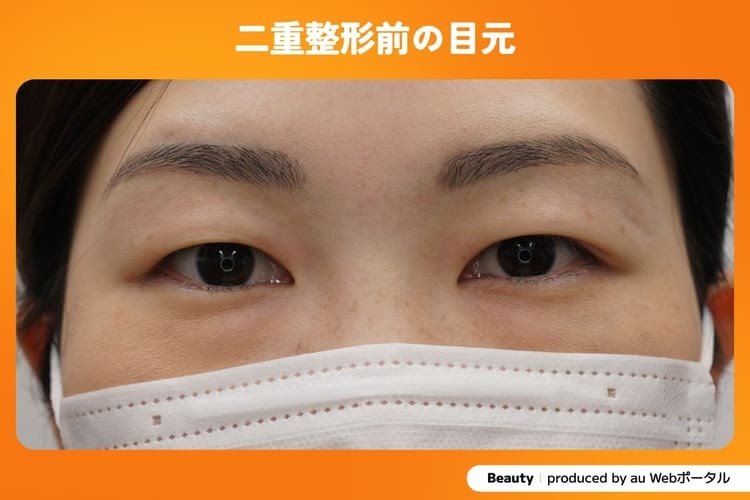 二重整形をする前の目元