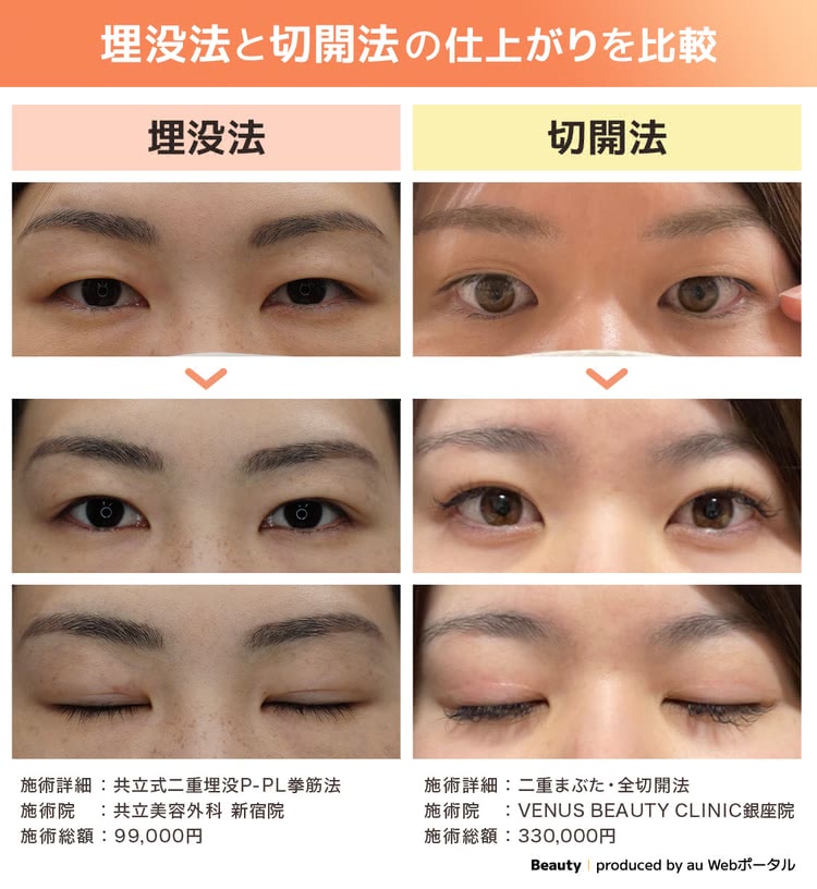 埋没法と切開法の症例写真を比較