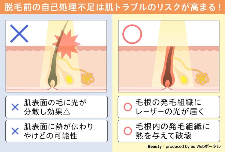 脱毛前のシェービングの重要性