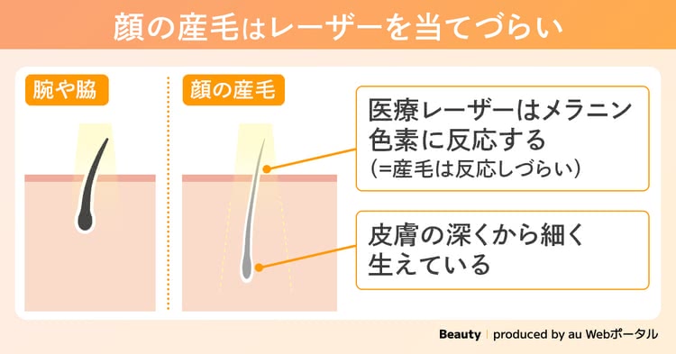 顔の産毛は医療脱毛の効果が出にくい理由を解説